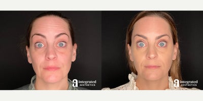 Case 4760 - 35-44 year old woman treated with Botox, Sculptra