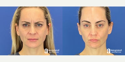 Case 4761 - 35-44 year old woman treated with Botox