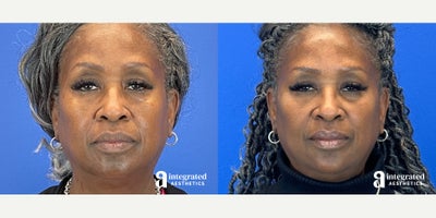 Case 4763 - 55-64 year old woman treated with Botox, Restylane, Voluma