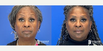 Case 4764 - 55-64 year old woman treated with Botox, Restylane, Voluma