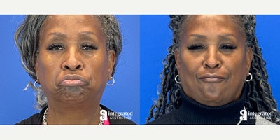 Case 4765 - 55-64 year old woman treated with Botox, Restylane, Voluma