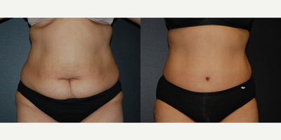 Case 477 - Woman treated with Tummy Tuck