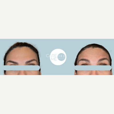 Case 4773 - 35-44 year old woman treated with Botox