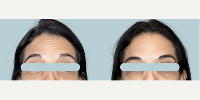 Case 4774 - 25-34 year old woman treated with Botox