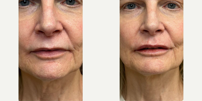 Case 4779 - Woman treated with Botox