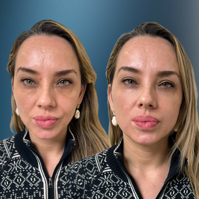 Case 4783 - 35-44 year old woman treated with Vampire Facelift, Botox, PRP Injections, Radiesse