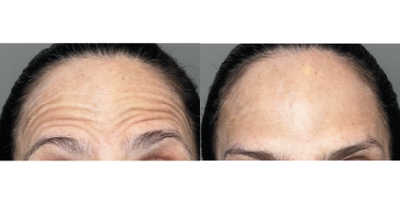 Case 4787 - 45-54 year old woman treated with Botox