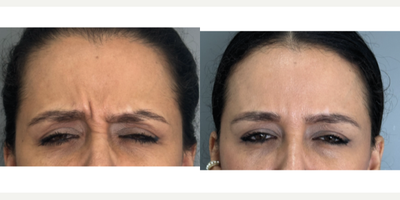 Case 4790 - 35-44 year old woman treated with Botox