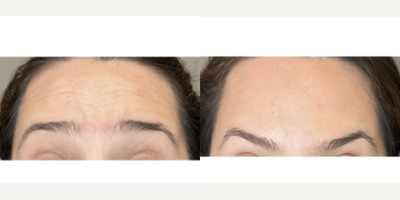 Case 4793 - 25-34 year old woman treated with Botox