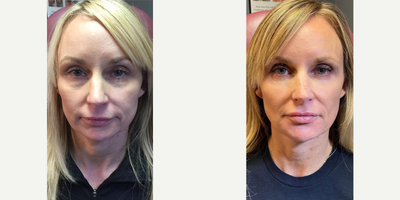 Case 4795 - 35-44 year old woman treated with Liquid Facelift, Dermal Fillers, Botox, Dysport