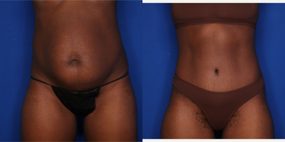 Case 48 - 25-34 year old woman treated with Tummy Tuck