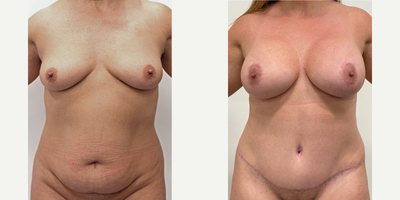Case 480 - 45-54 year old woman treated with Mommy Makeover, Tummy Tuck, Breast Lift