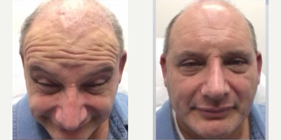 Case 4803 - Man treated with Botox