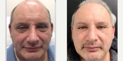 Case 4804 - Man treated with Botox