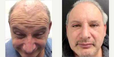 Case 4805 - Man treated with Botox