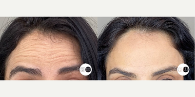 Case 4806 - 35-44 year old woman treated with Botox