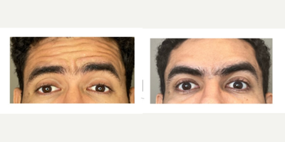 Case 4807 - 25-34 year old man treated with Botox