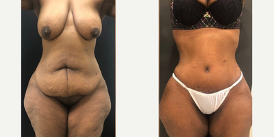 Case 481 - 45-54 year old woman treated with Tummy Tuck