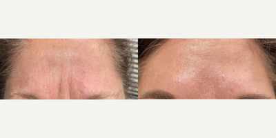 Case 4815 - Woman treated with Botox