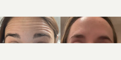 Case 4816 - Woman treated with Botox