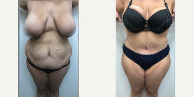 Case 482 - 45-54 year old woman treated with Tummy Tuck