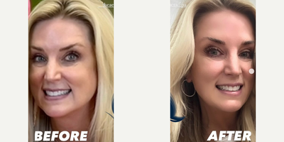 Case 4853 - Woman treated with Botox