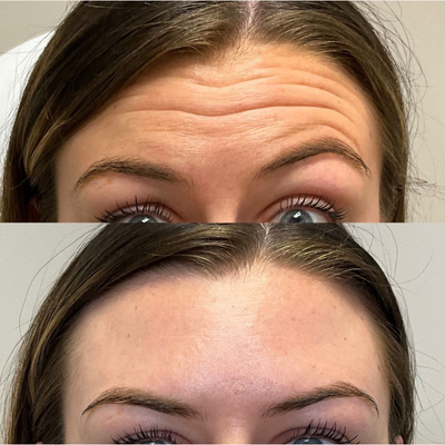 Case 4877 - 25-34 year old woman treated with Botox, Jeuveau, Dysport, Daxxify