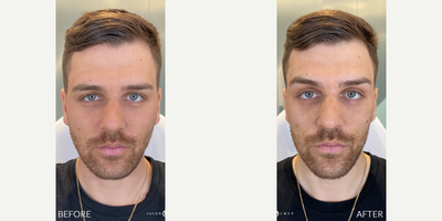 Case 4878 - FACIAL SCULPTING + BOTOX REFRESHER