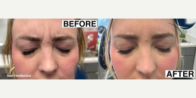 Case 4884 - Woman treated with Botox