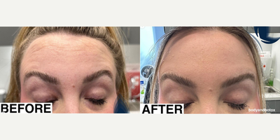 Case 4885 - Woman treated with Botox