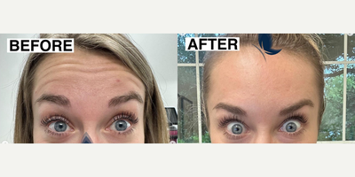 Case 4886 - Woman treated with Botox