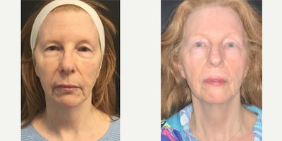 Case 4888 - 55-64 year old woman treated with NeoGen Plasma, Restylane, Lip Fillers, Dysport, Botox
