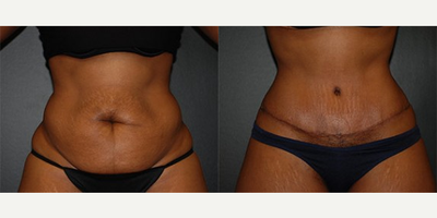 Case 489 - Woman treated with Tummy Tuck
