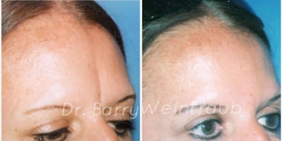 Case 4897 - Woman treated with Botox