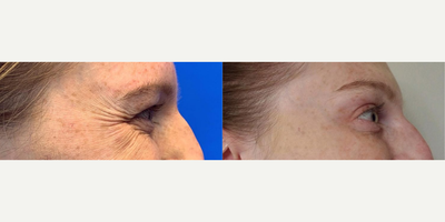 Case 4898 - Woman treated with Botox