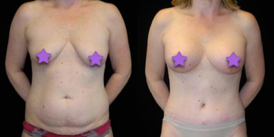 Case 49 - Woman treated with Tummy Tuck
