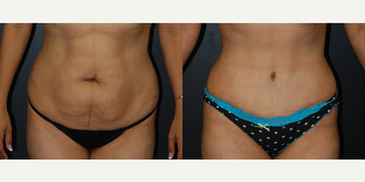 Case 490 - Woman treated with Tummy Tuck