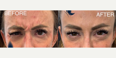 Case 4907 - Woman treated with Botox