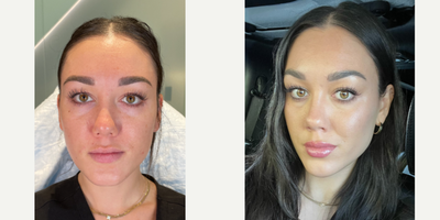 Case 4908 - 25-34 year old woman treated with Botox, Lip Fillers, Chin Filler