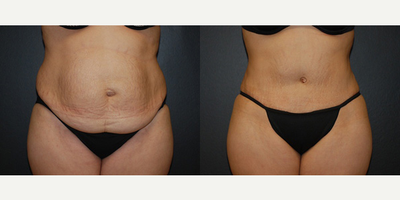 Case 491 - Woman treated with Tummy Tuck