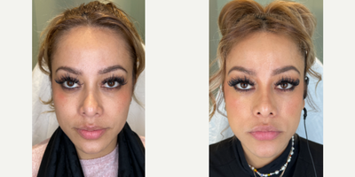 Case 4910 - 25-34 year old woman treated with Botox