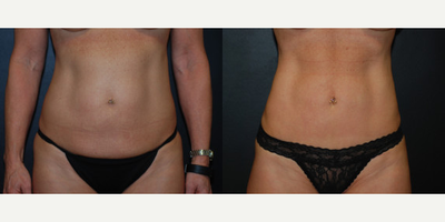 Case 492 - Woman treated with Tummy Tuck, Vaser Liposuction