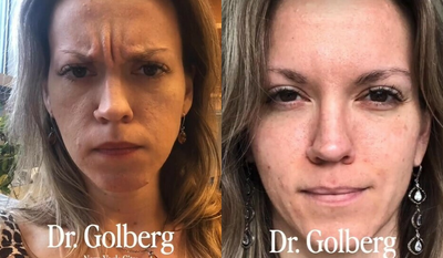 Case 4929 - Woman treated with Botox