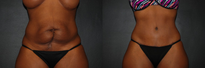 Case 493 - Woman treated with Tummy Tuck