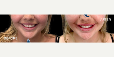 Case 4932 - Woman treated with Botox, Lip Fillers