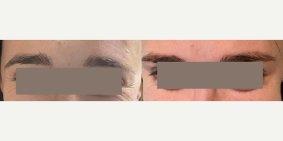 Case 4933 - Woman treated with Botox