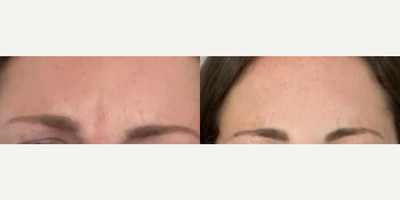 Case 4934 - Woman treated with Botox