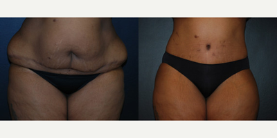 Case 494 - Woman treated with Tummy Tuck