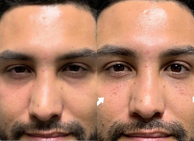 Case 4949 - Man treated with Dermal Fillers, Botox