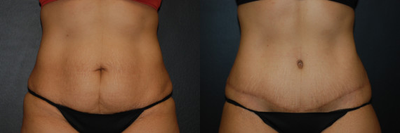 Case 495 - Woman treated with Tummy Tuck